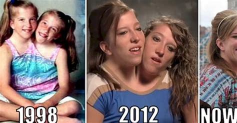 conjoined twins porn|Conjoined Twims Porn Videos .